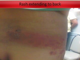 Rash extending to back
 