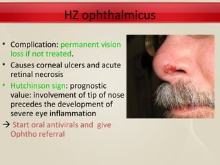 HZ ophthalmicus

• Complication: permanent vision
  loss if not treated.
• Causes corneal ulcers and acute
  retinal necrosis
• Hutchinson sign: prognostic
  value: involvement of tip of nose
  precedes the development of
  severe eye inflammation
 Start oral antivirals and give
  Ophtho referral
 