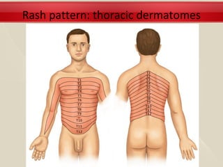 Rash pattern: thoracic dermatomes
 