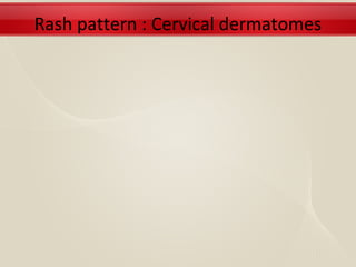 Rash pattern : Cervical dermatomes
 