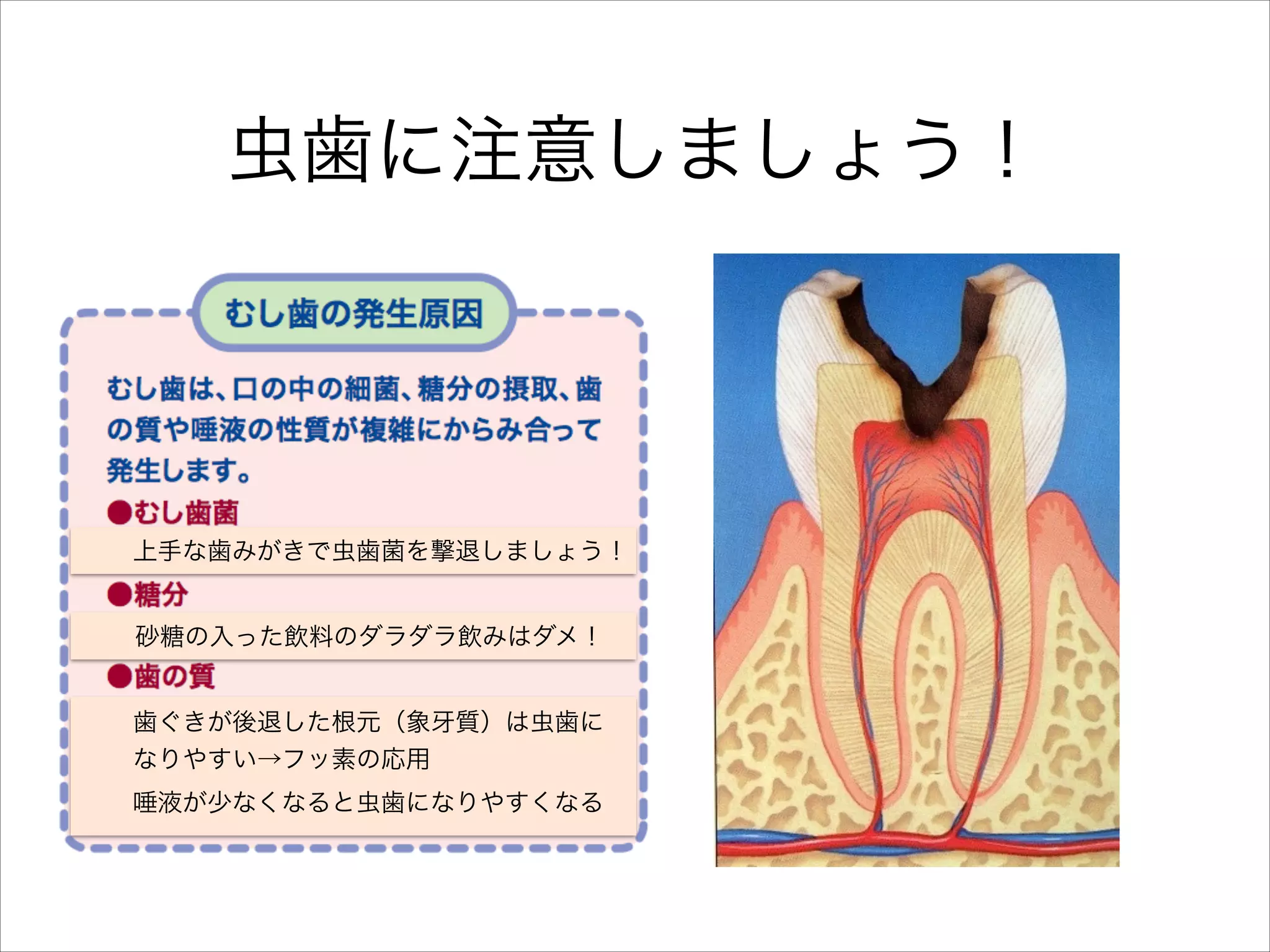 虫歯に注意しましょう！

上手な歯みがきで虫歯菌を撃退しましょう！
砂糖の入った飲料のダラダラ飲みはダメ！
歯ぐきが後退した根元（象
なりやすい→フッ素の応用

質）は虫歯に

唾液が少なくなると虫歯になりやすくなる

 