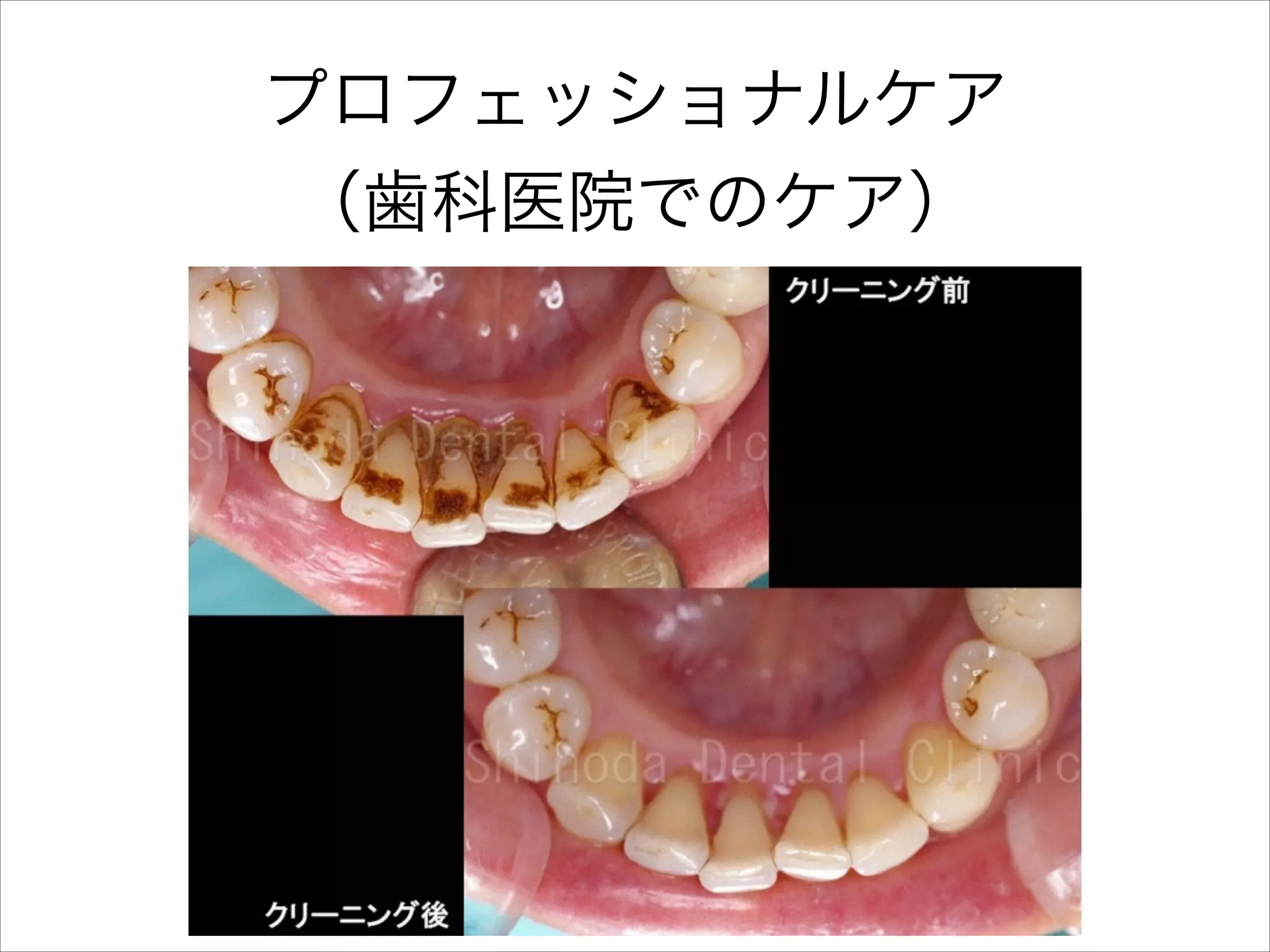 プロフェッショナルケア
（歯科医院でのケア）

 