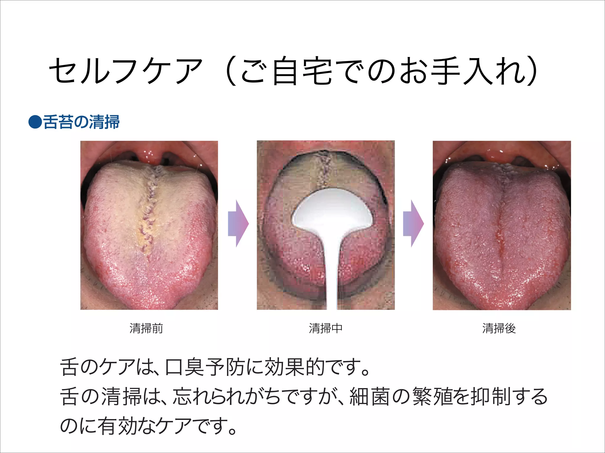 セルフケア（ご自宅でのお手入れ）

舌のケアは、
口臭予防に効果的です｡
舌の清掃は、
忘れられがちですが、
細菌の繁殖を抑制する
のに有効なケアです｡

歯
歯
進

 