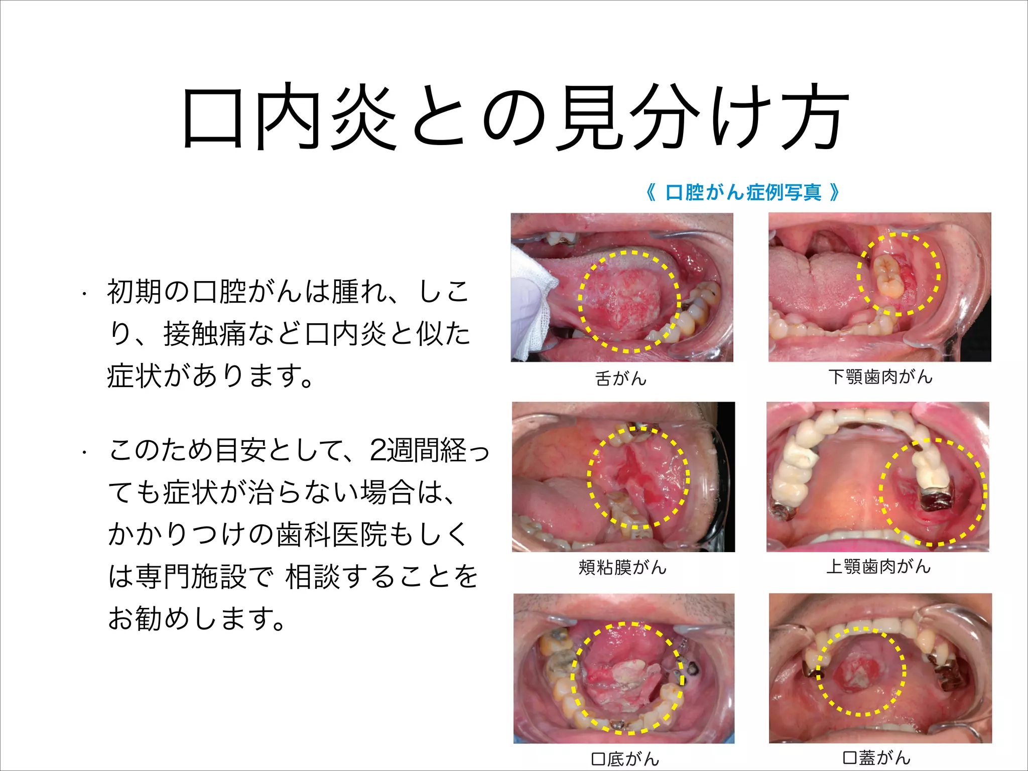 予測されています。
 また死亡率が高く、
40％の方が亡くなっている事
ら、
より一層の早期発見・早期治療が必要とされ
います。
口腔がん罹患の男女比は、
およそ３
：2 と
性に多く、
好発年齢は 60 歳代です。

頬粘膜

舌

11％

55％

下顎歯肉
15％

頬粘膜
舌
口底

口内炎との見分け方
下顎歯肉

資料：東京医科歯科大学顎口腔外科
   臨床統計
（2001年∼2012 年）

口唇

《 口腔がん症例写真 》

•

初期の口腔がんは腫れ、しこ
り、接触痛など口内炎と似た
症状があります。
（予測値）

資料：国立がん研究センターがん対策情報センター
このため目安として、2週間経っ
ても症状が治らない場合は、
口腔がんの種類
かかりつけの歯科医院もしく
 口腔がんには、舌に発生する舌がん、上顎と下顎
は専門施設で 相談することを
の歯肉に発生する歯肉がん、舌と下顎歯肉の間（口
底）に発生する口底がん、頬の内側に発生する頬粘
お勧めします。

舌がん

下顎歯肉がん

頬粘膜がん

上顎歯肉がん

口底がん

口蓋がん

•

膜がん、口の中の天井部分に発生する口蓋がん、上
下の口唇に発生する口唇がんがあります。口腔がん
の多くは口腔の粘膜に発生しますが、唾液をつくる
組織から発生する唾液腺がんもあります。
 この中で最も発生頻度が高いのが舌がんで、口腔

 