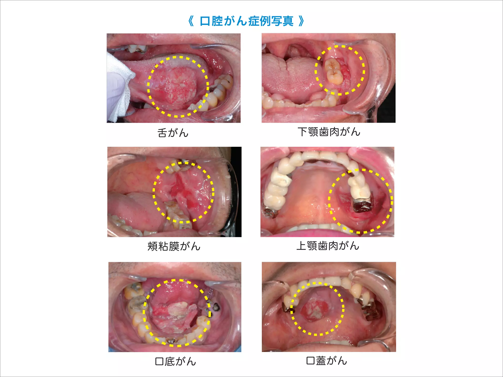《 口腔がん症例写真 》

 画像検査は
行度合いを調
 これらの結
きます。

口腔がん

（予測値）

舌がん

下顎歯肉がん

頬粘膜がん

上顎歯肉がん

口底がん

口蓋がん

ん対策情報センター

上顎と下顎
肉の間（口
生する頬粘
蓋がん、上
。口腔がん
液をつくる
。
んで、口腔

 外 科 手 術、
があります。
慮してこれら
治療方法を選
 早期がんに
療が、進行し
ます。しかし
能面だけでな
に深く関与し
機能と容姿を
します。
 頸部リンパ
は、頸部リン
す。また、
広範
たり、身体の
もとの状態に

 