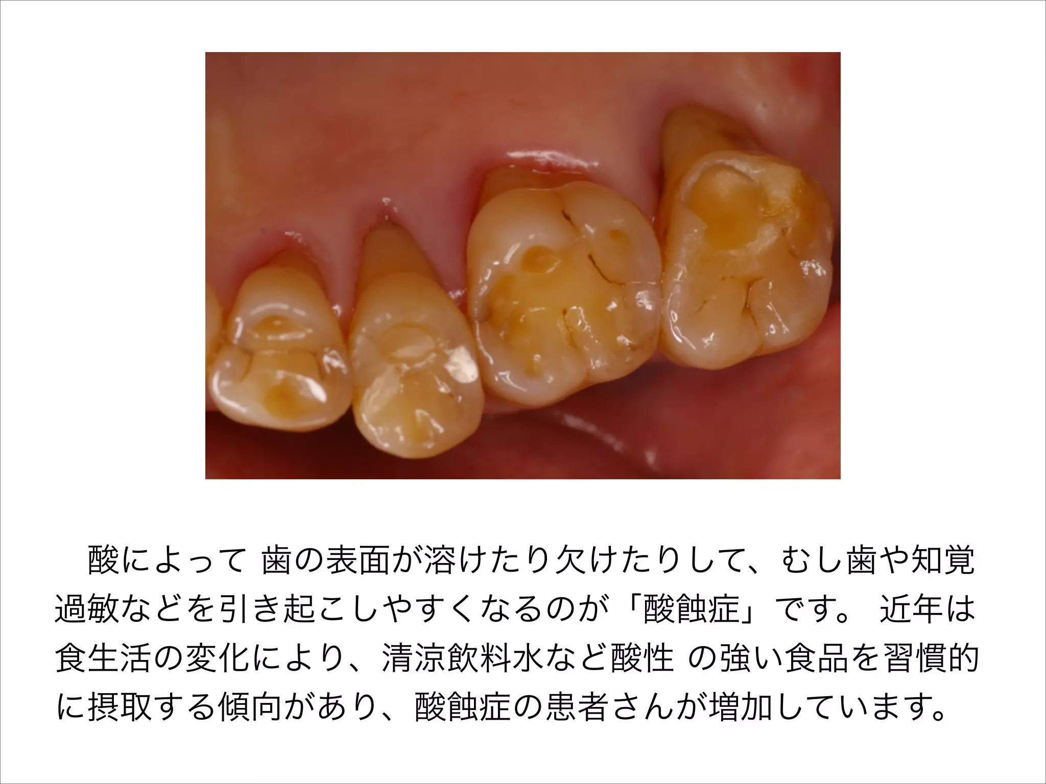 酸によって 歯の表面が溶けたり欠けたりして、むし歯や知覚
過敏などを引き起こしやすくなるのが「酸 症」です。 近年は
食生活の変化により、清涼飲料水など酸性 の強い食品を習慣的
に摂取する傾向があり、酸 症の患者さんが増加しています。

 