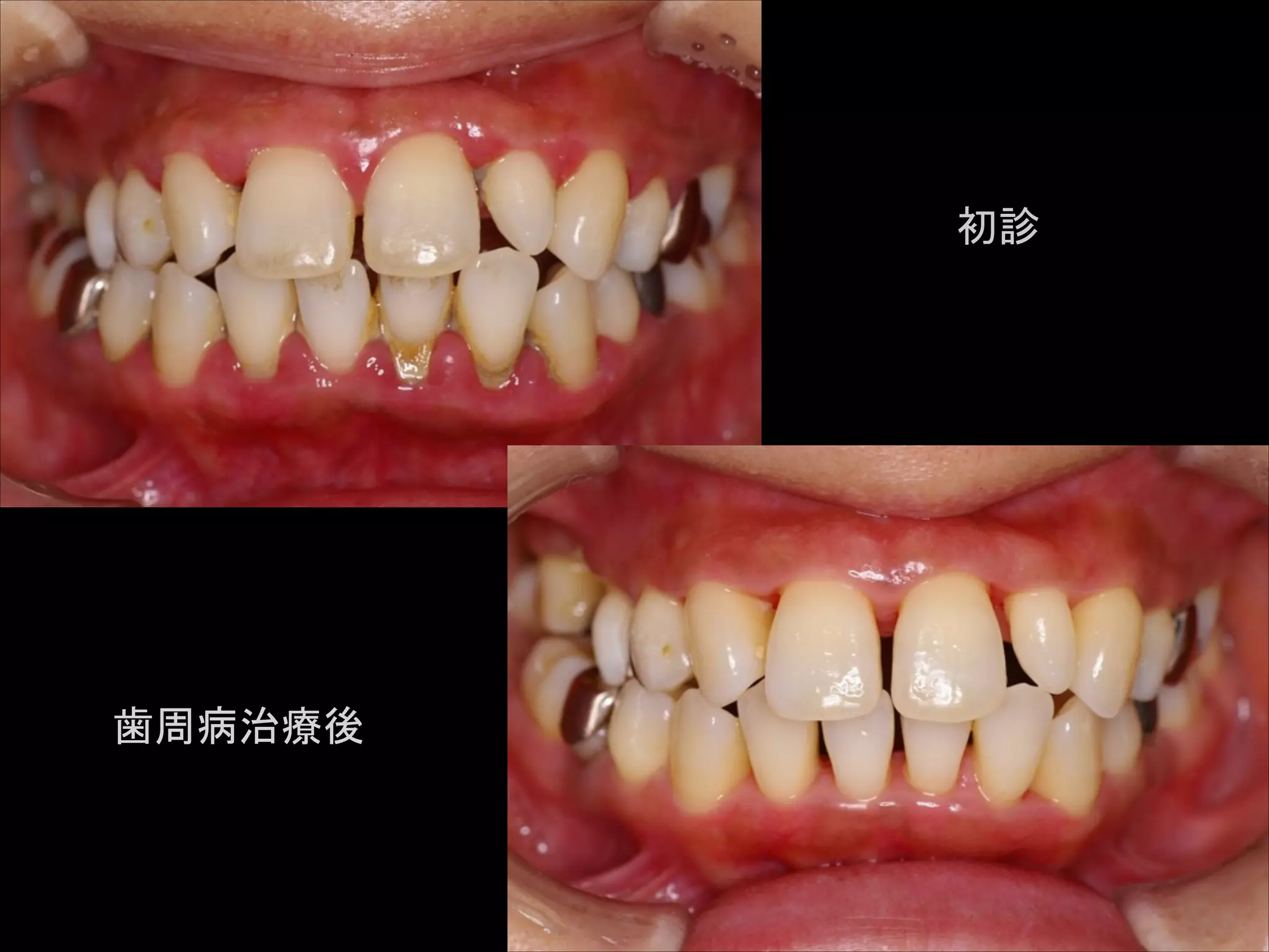 初診

歯周病治療後

 