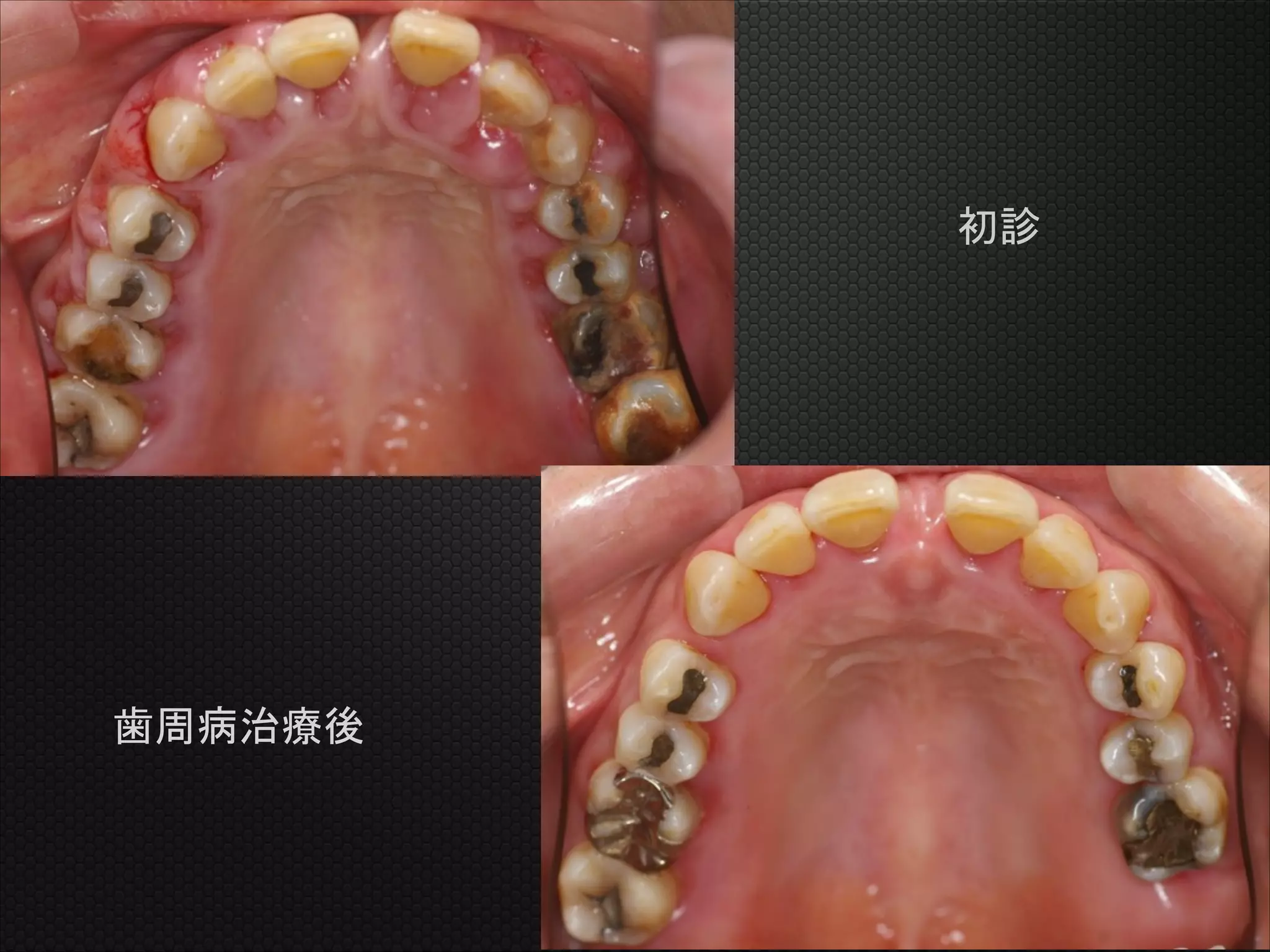 初診

歯周病治療後

 