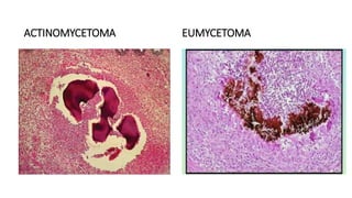 ACTINOMYCETOMA EUMYCETOMA
 