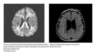 There is a profound injury to the whole corpus callosum that
shows diffusion restriction on DWI. Sparing of the cortical and
deep grey matter and
the basal nuclei.
Bilateral hyperintense signals are seen in
watershed area.
 