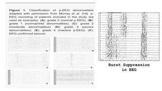 Burst Suppression
in EEG
 