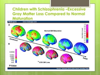 Children with Schizophrenia –Excessive
Gray Matter Loss Compared to Normal
Maturation
 