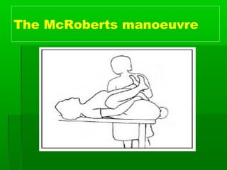 The McRoberts manoeuvre
 