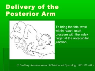 Delivery of the
Posterior Arm

                                       To bring the fetal wrist
                                        within reach, exert
                                        pressure with the index
                                        finger at the antecubital
                                        junction.




   (E. Sandberg. American Journal of Obstetrics and Gynecology, 1985; 152: 481.)
 