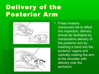 Delivery of the
Posterior Arm
              If less invasive
               maneuvers fail to affect
               this impaction, delivery
               should be facilitated by
               manipulative delivery of
               the posterior arm by
               inserting a hand into the
               posterior vagina and
               ventrally rotating the arm
               at the shoulder with
               delivery over the
               perineum.
 