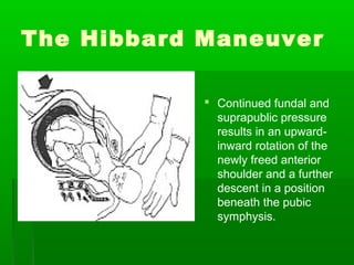 The Hibbard Maneuver

             Continued fundal and
              suprapublic pressure
              results in an upward-
              inward rotation of the
              newly freed anterior
              shoulder and a further
              descent in a position
              beneath the pubic
              symphysis.
 