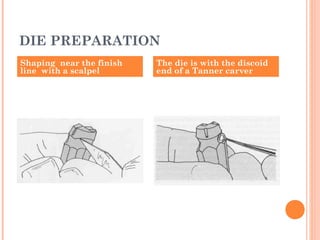 DIE PREPARATION
Shaping near the finish
line with a scalpel
The die is with the discoid
end of a Tanner carver
 