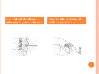 the ends of the dowel
pins are tapped to loosen
Base of die is trimmed
with an acrylic bur.
 