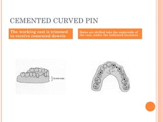 CEMENTED CURVED PIN
The working cast is trimmed
to receive cemented dowels
Holes are drilled into the underside of
the cast, under the indicated locations
 