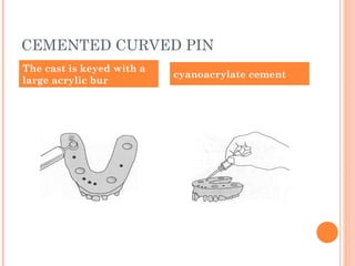 CEMENTED CURVED PIN
The cast is keyed with a
large acrylic bur
cyanoacrylate cement
 