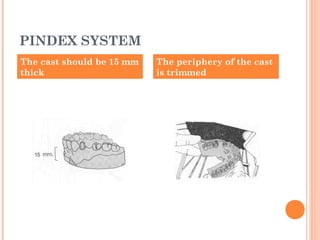 PINDEX SYSTEM
The cast should be 15 mm
thick
The periphery of the cast
is trimmed
 