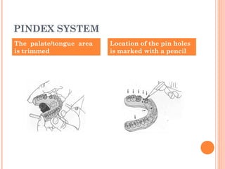 PINDEX SYSTEM
The palate/tongue area
is trimmed
Location of the pin holes
is marked with a pencil
 