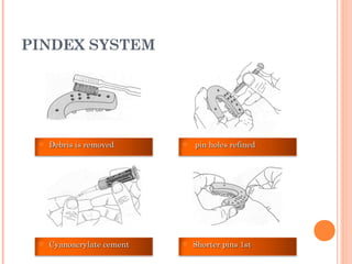 PINDEX SYSTEM
 Debris is removedDebris is removed  pin holes refinedpin holes refined
 Shorter pins 1stShorter pins 1st Cyanoacrylate cementCyanoacrylate cement
 