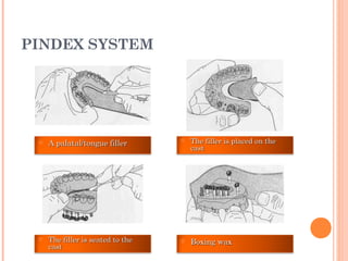 PINDEX SYSTEM
 A palatal/tongue fillerA palatal/tongue filler  The filler is placed on theThe filler is placed on the
castcast
 Boxing waxBoxing wax The filler is seated to theThe filler is seated to the
castcast
 