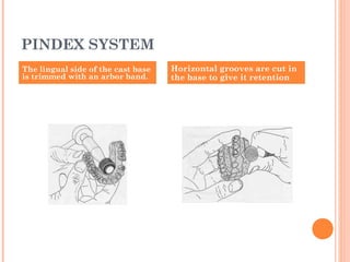 PINDEX SYSTEM
The lingual side of the cast base
is trimmed with an arbor band.
Horizontal grooves are cut in
the base to give it retention
 