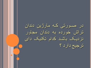 ‫دندان‬ ‫مارژین‬ ‫که‬‫ک‬‫ک‬ ‫کورتی‬‫ک‬‫ص‬ ‫در‬‫دندان‬ ‫مارژین‬ ‫که‬‫ک‬‫ک‬ ‫کورتی‬‫ک‬‫ص‬ ‫در‬
‫مجاور‬ ‫دندان‬ ‫به‬ ‫خورده‬ ‫تراش‬‫مجاور‬ ‫دندان‬ ‫به‬ ‫خورده‬ ‫تراش‬
‫دای‬ ‫تکنیک‬ ‫کدام‬ ‫کد‬‫ک‬‫باش‬ ‫کک‬‫ک‬‫نزدی‬‫دای‬ ‫تکنیک‬ ‫کدام‬ ‫کد‬‫ک‬‫باش‬ ‫کک‬‫ک‬‫نزدی‬
‫؟‬ ‫دارد‬ ‫ترجیح‬‫؟‬ ‫دارد‬ ‫ترجیح‬
 