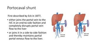 Portocaval shunt
First described by Eck in 1877,
• either joins the portal vein to the
IVC in an end-to-side fashion and
completely disrupts portal vein
flow to the liver
• or joins it in a side-to-side fashion
and thereby maintains partial
portal venous flow to the liver.
 