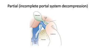 Partial (incomplete portal system decompression)
 