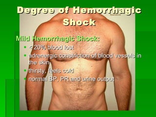 Degree of Hemorrhagic Shock Mild Hemorrhagic Shock: < 20% blood lost adrenergic constriction of blood vessels in the skin thirsty, feels cold normal BP, PR and urine output 