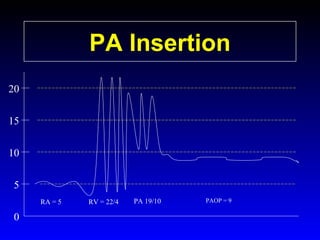 PA Insertion
20
15
10
5
RA = 5

0

RV = 22/4

PA 19/10

PAOP = 9

 