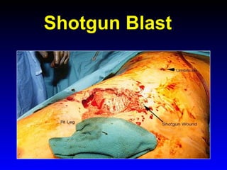 Shotgun Blast

 
