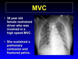 MVC
• 38 year old
female restrained
driver who was
involved in a
high speed MVC.
• She sustained a
pulmonary
contusion and
fractured pelvis.

 