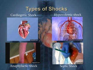 Cardiogenic Shock Hypovolemic shock 
Anaphylactic Shock Septic Shock 
 