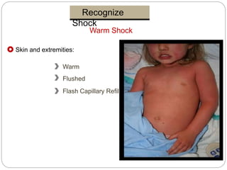 Recognize
Shock
Warm Shock
Skin and extremities:
Warm
Flushed
Flash Capillary Refill
 