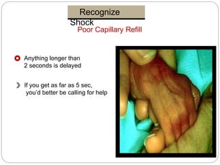 Recognize
Shock
Poor Capillary Refill
Anything longer than
2 seconds is delayed
If you get as far as 5 sec,
you’d better be calling for help
 