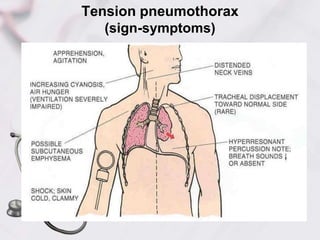 Tension pneumothorax
(sign-symptoms)
 