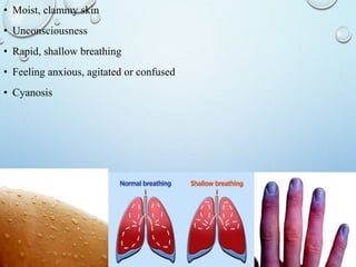 • Moist, clammy skin
• Unconsciousness
• Rapid, shallow breathing
• Feeling anxious, agitated or confused
• Cyanosis
 