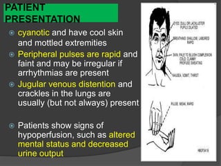CARDIOGENIC SHOCK — BACKGROUNDPATIENT
PRESENTATION
 cyanotic and have cool skin
and mottled extremities
 Peripheral pulses are rapid and
faint and may be irregular if
arrhythmias are present
 Jugular venous distention and
crackles in the lungs are
usually (but not always) present
 Patients show signs of
hypoperfusion, such as altered
mental status and decreased
urine output
 