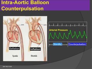 Diastole
Inflation
Systole
Intra-Aortic Balloon
Counterpulsation
Standby Counterpulsation
Arterial Pressure
SMH #619 2008
Deflation Inflation
 