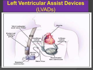 Left Ventricular Assist Devices
(LVADs)
 