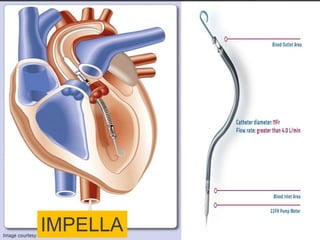 IMPELLA
 