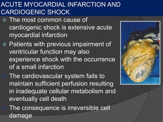 CARDIOGENIC SHOCK — BACKGROUNDACUTE MYOCARDIAL INFARCTION AND
CARDIOGENIC SHOCK
 The most common cause of
cardiogenic shock is extensive acute
myocardial infarction
 Patients with previous impairment of
ventricular function may also
experience shock with the occurrence
of a small infarction
 The cardiovascular system fails to
maintain sufficient perfusion resulting
in inadequate cellular metabolism and
eventually cell death
 The consequence is irreversible cell
damage
 