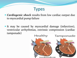 Types
 Cardiogenic shock results from low cardiac output due
to myocardial pump failure
 It may be caused by myocardial damage (infarction),
ventricular arrhythmias, extrinsic compression (cardiac
tamponade)
 