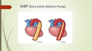 IABP (Intra Aortic Balloon Pump)
 