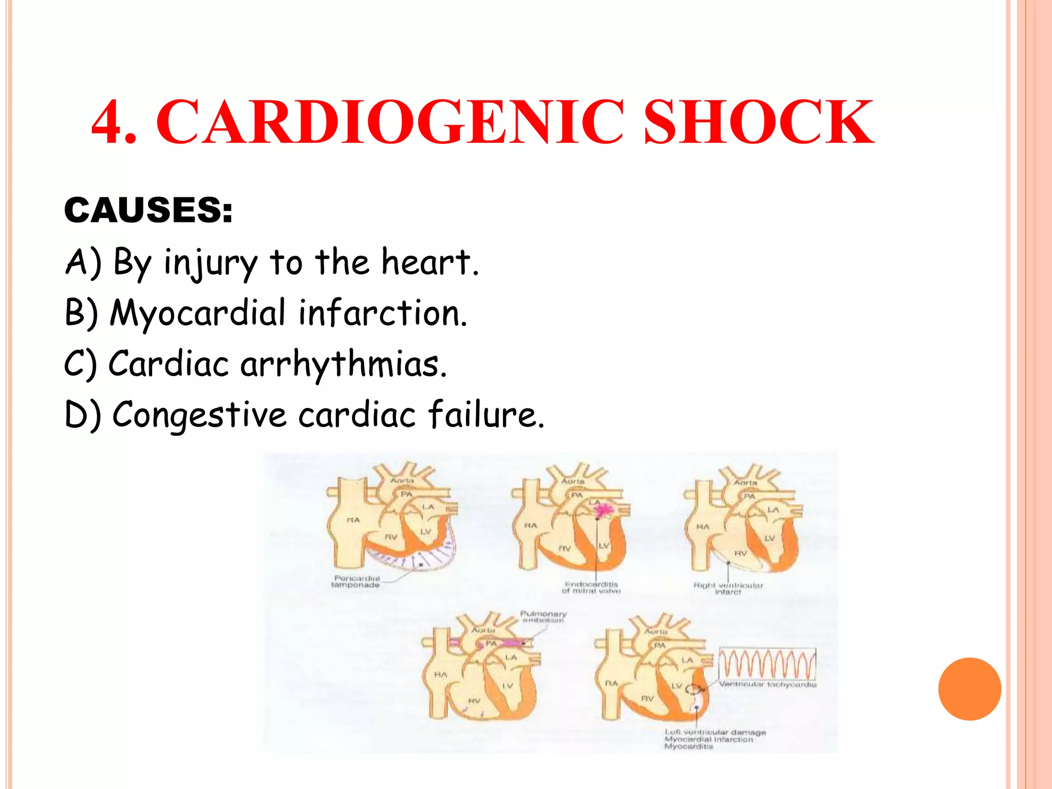 4. CARDIOGENIC SHOCK
CAUSES:
A) By injury to the heart.
B) Myocardial infarction.
C) Cardiac arrhythmias.
D) Congestive cardiac failure.
 