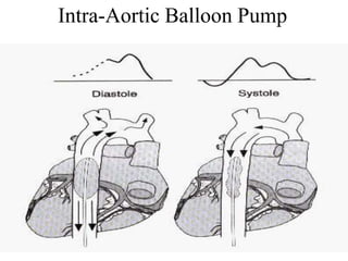 Intra-Aortic Balloon Pump
 